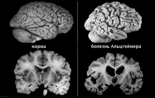 МРТ признаки болезни Альцгеймера